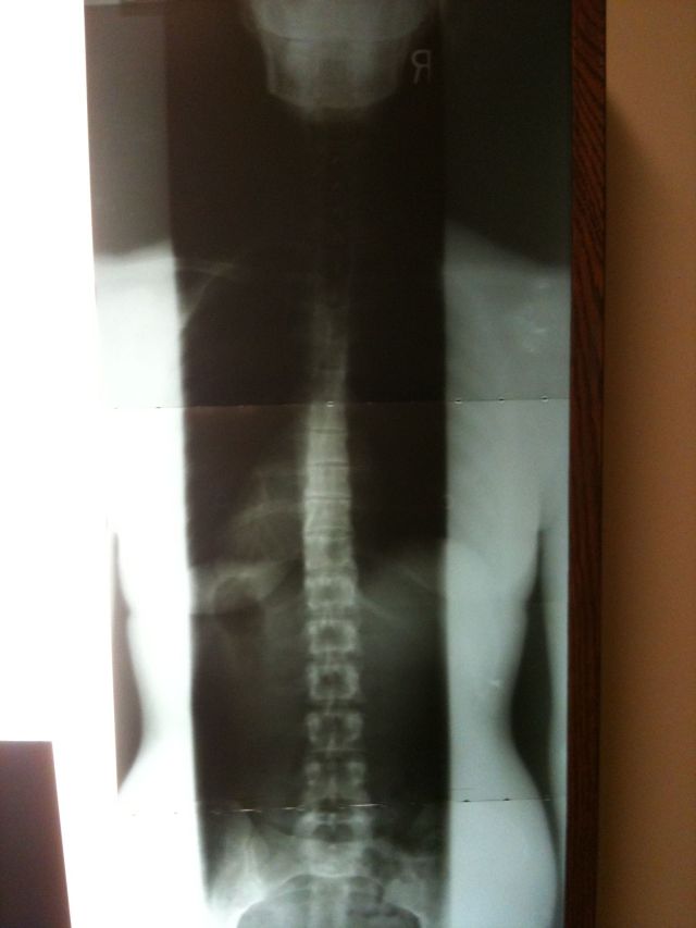 28 year-old female's spinal x-ray