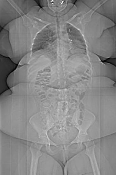 12 year-old boy's spinal x-ray